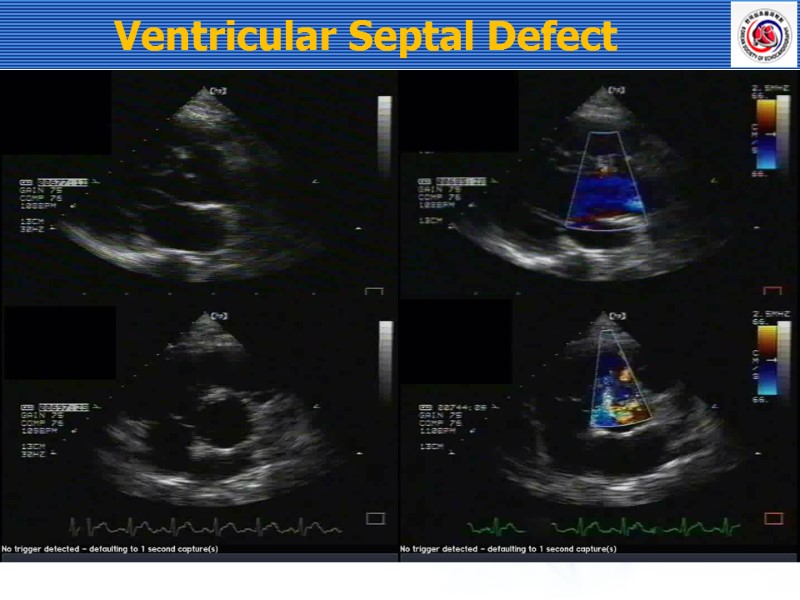 Ventricular Septal Defect